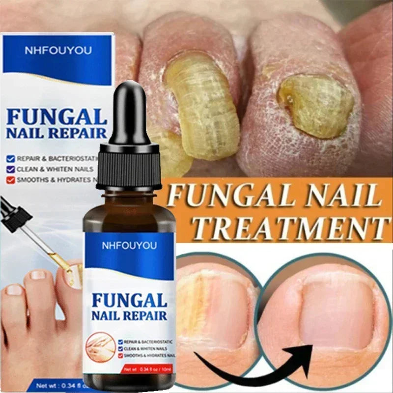 Nail Fungus Treatment  Serum Toe  Fungal Repair