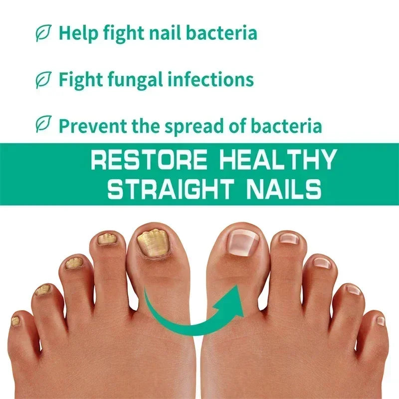Nail Fungus Treatment  Serum Toe  Fungal Repair