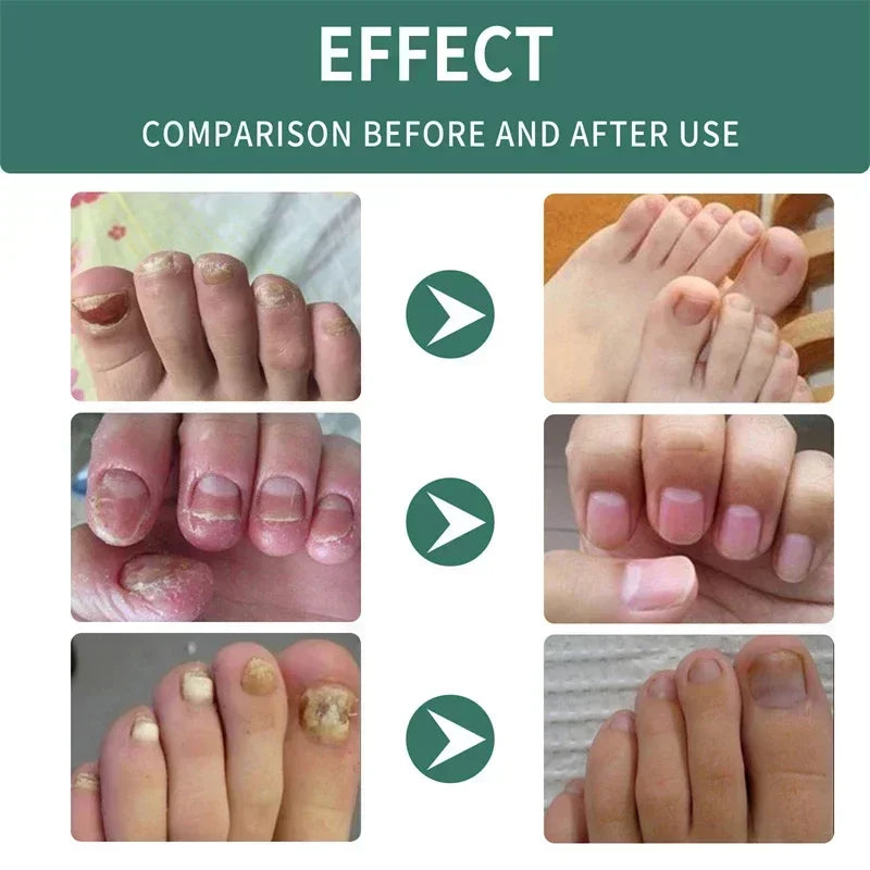 Nail Fungus Treatment  Serum Toe  Fungal Repair