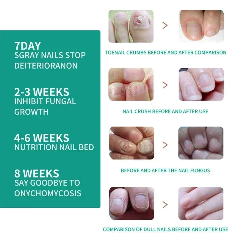 Nail Fungus Treatment  Serum Toe  Fungal Repair